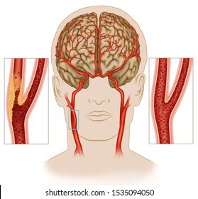 Carotid artery disease, these affect the blood vessels that lead to the head and brain, the carotid becomes clogged and the brain does not receive enough oxygen.