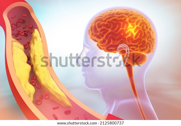 Carotid Artery Problems, Brain stroke.\
clogged veins with human brain. 3d\
illustration	