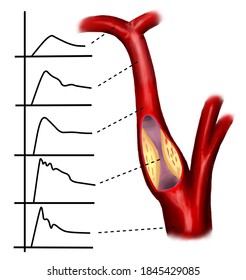 The Carotid Artery Stenosis And Doppler Study.