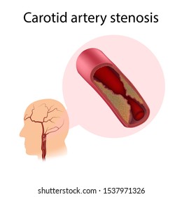 Carotid Artery Stenosis. Plaque Narrows A Vessel. Atherosclerosis. Medical Illustration.