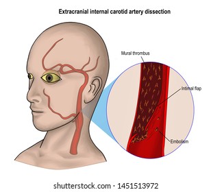 the carotid dissection is the tearing of wall of carotid artery. it can causes carotid occlusion, carotid stenosis and ischemic stroke.