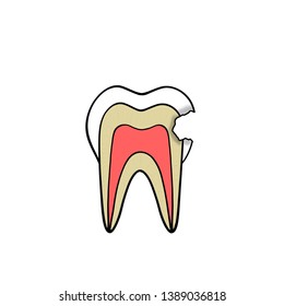 Cartoon Drawing Dental Caries Proximal Side Stock Illustration ...