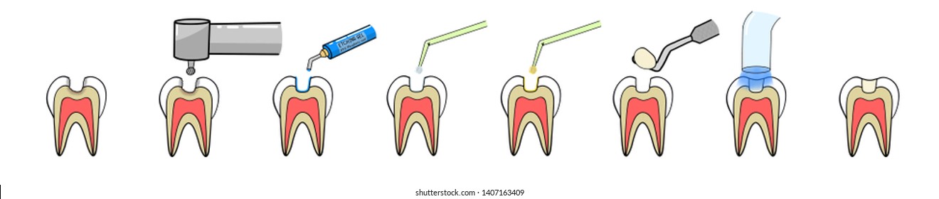 Cartoon drawing of step of dental filling from cavity preparation to filling resin composite