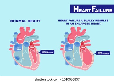 Cartoon Heart Failure Concept On The Green Background