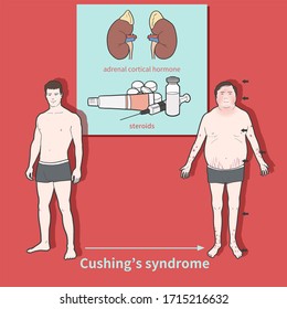 
Cartoon Medical Illustration To Explain Cushing's Syndrome