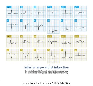 Case Inferior Myocardial Infarction Blood Vessel Stock Illustration ...