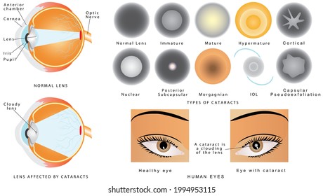 Cataract Eye Disease Cataract Structure Eye Stock Illustration ...