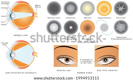 Cataract. Eye disease cataract. The structure of the eye. A cataract is an clouding crystalline lens inside the eye. Eye cataracts affected. Types of Cataract