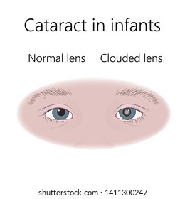 Cataract In Infants, Child, Kid. Clouded Lens And Normal. Flat Medical Illustration.