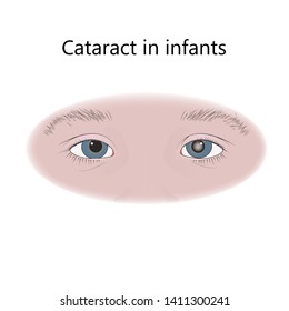 Cataract In Infants, Child, Kid. Flat Medical Illustration.