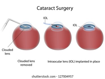 Cataract Surgery