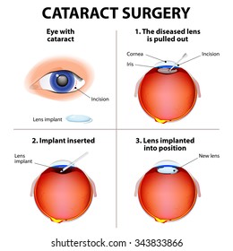 Cataract Surgery.