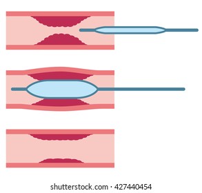 Catheter Treatment Of Coronary Artery 