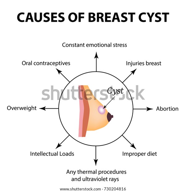 Causes Cyst Mammary Gland World Breast Stock Illustration 730204816