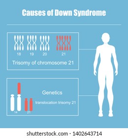 Causes of Down Syndrome.Trisomy of chromosome 21.