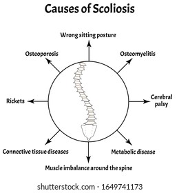 Causes Scoliosis Spinal Curvature Kyphosis Lordosis Stock Illustration ...