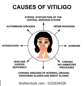 Treatment vitiligo Vitiligo Treatments
