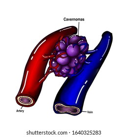 The Cavernomas Is The Abnormal Developing Of Capillary Bed. It Is Composed Of Dilated Thin Wall Blood Vessel Which Can Cause Hemorrhage In Brain And Spinal Cord. 