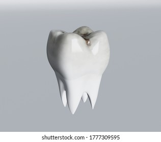 Cavities Of Molar Tooth, Tooth Decay, Caries. 3d Illustration