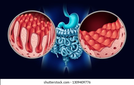 Celiac Or Coeliac Disease As An Intestine Anatomy Medical Concept With Normal Villi And Damaged Small Bowel Lining As An Autoimmune Disorder Of The Digestion System As A 3D Illustration.