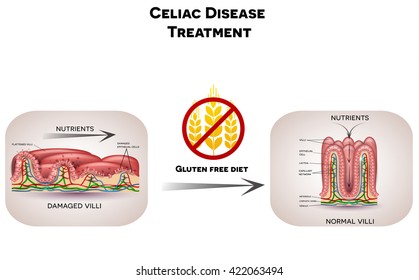 Celiac Disease Treatment. Nutrients Are Not Absorbed Because Of Reduced Surface Area. Gluten Free Diet Leads To Healthy Intestinal Villi.