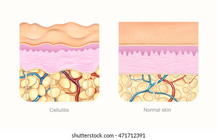 Cellulite Skin Compare To Normal Skin Visualization