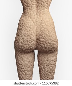 Cellulite Texture On The Human Skin (illustration Concept)