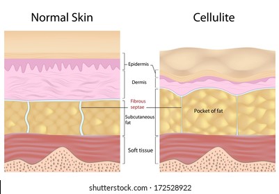 Cellulite versus smooth skin labeled