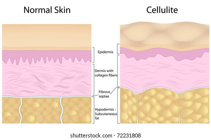 Cellulite Versus Smooth Skin, Labeled