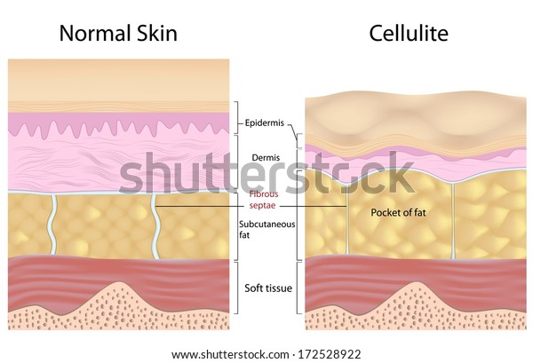 Cellulite Versus Smooth Skin Labeled Stock Illustration 172528922 ...