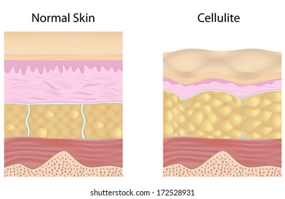 Cellulite Versus Smooth Skin Unlabeled