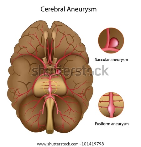 Cerebral aneurysm