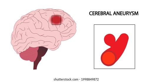 Cerebral Aneurysm. Artery aneurysm illustration