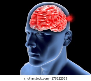 Cerebral Aneurysm, Brain Head 