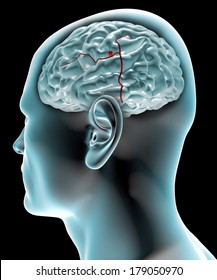 Cerebral Aneurysm, Brain Head 