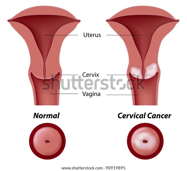 cervix cancer
