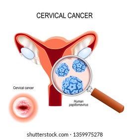 Cervical Cancer. Carcinoma is Malignant neoplasm arising from cells in the cervix uteri. Close-up of Human papillomavirus infection (HPV). cut-away view of the uterus and cervix that viewed from below