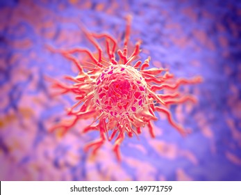 Cervical Cancer Cell, SEM Of Cervical Carcinoma