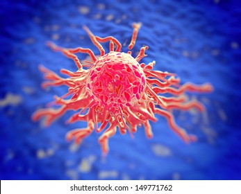 Cervical Cancer Cell, SEM Of Cervical Carcinoma