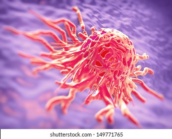 Cervical Cancer Cell, SEM Of Cervical Carcinoma