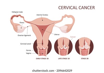 Cervical cancer development image. Cervix carcinoma stages. Female reproductive system. Anatomy. Gynecology.
