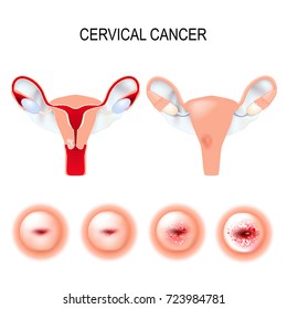 Cervical Cancer Staging.  Carcinoma Of Cervix. Malignant Neoplasm Arising From Cells In The Cervix Uteri. Vaginal Bleeding. 