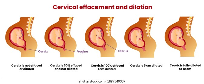 Cervical Effacement And Dilation During Childbirth. 1 Cm, 5 Cm And 10 Cm Dilated. Realistic Medical Illustration