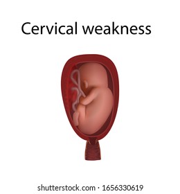 Cervical Weakness Fetus Uterus Womb Placenta Stock-illustration ...