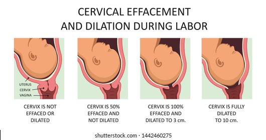 Cervix Thinning And Widening During Labor