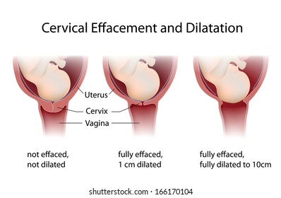 Cervix thinning and widening during labor