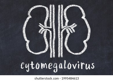 Chalk Drawing Of Human Kidneys And Medical Term Cytomegalovirus. Concept Of Learning Medicine.