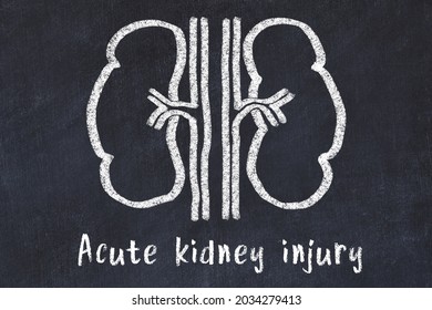 Chalk Drawing Of Human Kidneys And Medical Term Acute Kidney Injury. Concept Of Learning Medicine.