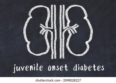 Chalk Drawing Of Human Kidneys And Medical Term Juvenile Onset Diabetes. Concept Of Learning Medicine.