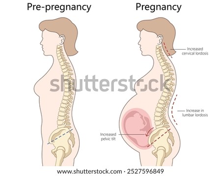 changes in spine alignment from pre-pregnancy to pregnancy, cervical lordosis, lumbar lordosis, pelvic tilt diagram hand drawn schematic raster illustration. Medical science educational illustration